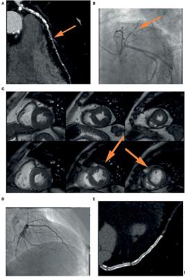 Frontiers | The Role of Multimodality Imaging for Percutaneous 